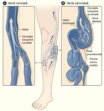 varicoza i tromboflebita cum sa tratam bold genunchi în varicoza